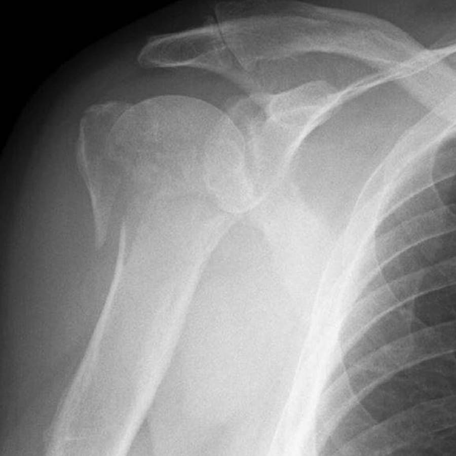 Fratura Úmero Proximal