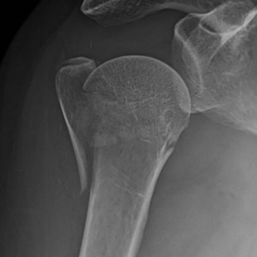 Fratura Úmero Proximal