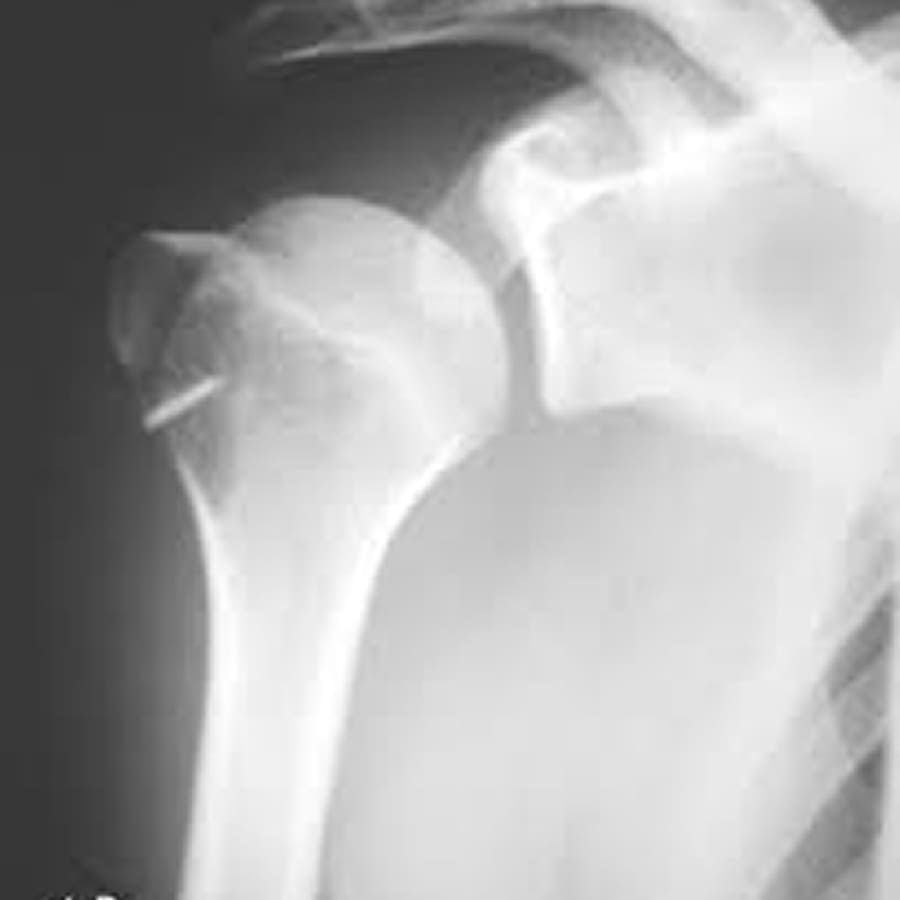 Fratura Úmero Proximal